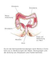 Morbus Crohn Chronisch Entzundliche Darmerkrankung Eesom Gesundheitsportal