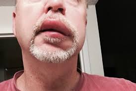 Anaphylaxis, also referred to as an anaphylactic reaction or anaphylactic shock, is a severe and these symptoms can lead to swelling of the tissues around the throat and face that are severe. Case Study Episodes Of Angioedema In A 51 Year Old Man Clinical Advisor
