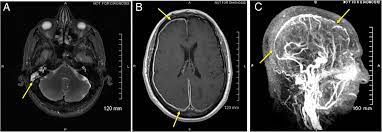 Cerebral venous thrombosis is an important cause of stroke especially in children and young adults. Cerebral Venous Sinus Thrombosis Secondary To Otomastoiditis Postgraduate Medical Journal