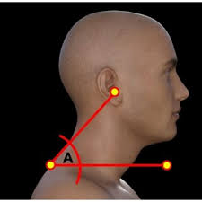 PDF) Is Thoracic Kyphosis Relevant to Pain, Autonomic Nervous System  Function, Disability, and Cervical Sensorimotor Control in Patients with  Chronic Nonspecific Neck Pain?