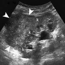 Online Cme Ultrasound Evaluation Of The Renal Transplant Ultrasound Sonography Ultrasound Medical Ultrasound