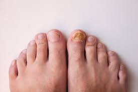 Actually, the fungus also has the same meaning with watering, washing your feet with soap daily and drying thoroughly. What Causes Toenail Fungus How Can It Be Treated Arizona Foot Doctors