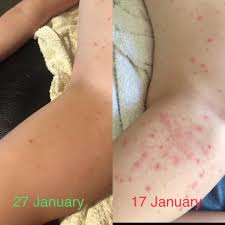 The result of the infection is usually a benign, mild skin disease characterized by lesions (growths) that may appear anywhere on the body. Mollenol Posts Facebook
