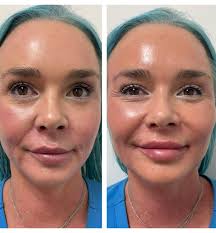Symmetry and balance using RHA filler combination to address cheeks,  jawline, chin, smile lines and lips 👄 These photos were taken immediately  before and after treatment, so there is swelling noted in