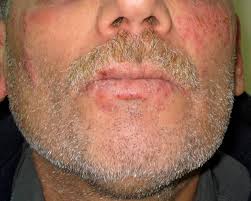 If a person has an hsv infection, they will pictures. Disseminated Primary Hsv 2 Infection Of The Face