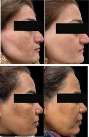 Topical isoniazid as a novel treatment for melasma: A randomized,  double‐blind, vehicle‐controlled clinical trial