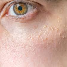 Many people experience white bumps on eyelid or under eyes. How To Get Rid Of Milia Causes Prevention And Removal