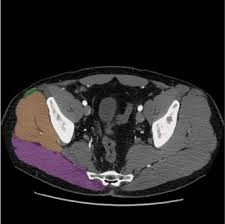 Want to learn more about it? Fasciotomy Basicmedical Key