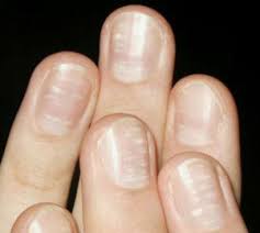 Image result for mykoza nehtů