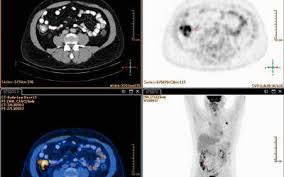 Hodgkin lymphoma (hl) is a type of lymphoma in which cancer originates from a specific type of white blood cells called lymphocytes. Nodular Sclerosing Hodgkin Lymphoma An Overview