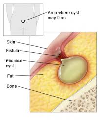 Image result for Pilonidal Cyst