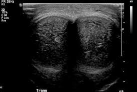 Image result for Priapism