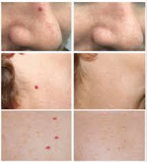 I work as a clinical technician at an eyecare place. Cherry Angioma The Aesthetics And Laser Clinic Ltd Facebook