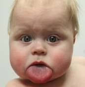 Characterization of the Beckwith‐Wiedemann spectrum: Diagnosis and  management