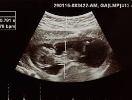 Check spelling or type a new query. News Snapshot Ohio Legislature Passes Bill Requiring Humane Burial For Aborted Babies