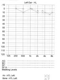 clinical junior com how to read audiogram and tympanogram