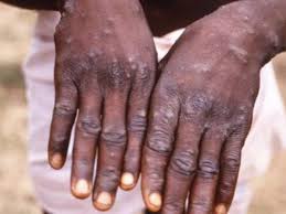 What monkeypox signs and symptoms were seen in pets? Monkeypox Case Confirmed In Singapore Patient Currently In Stable Condition