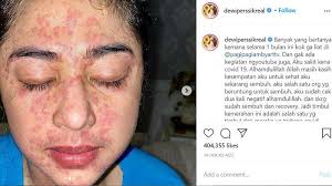 Tanda Tanda Tubuh Alami Ruam Kulit Seperti Dewi Perssik Gejala Terbaru Terpapar Covid 19 Tribunnewsmaker Com