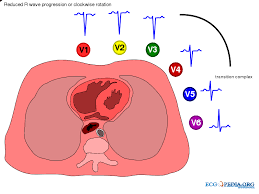 Image result for R Wave