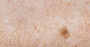 Banyak ahli berpendapat bahwa tanda lahir diwarisi dari orang tua atau anggota keluarga lainnya. Fakta Tentang Tanda Lahir Popmama Com