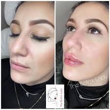 London/Lips/Fillers/Clinic (@the_botox_shop_london2) • Instagram photos and  videos