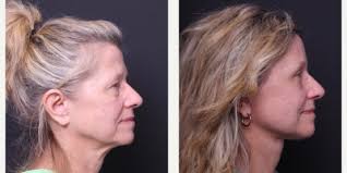 Mitchell Hagen, MD, Board Eligible Facial Plastic Surgeon