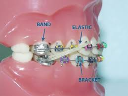 Multi Colored Bracers Bands Dental Braces Job Placement Tuition