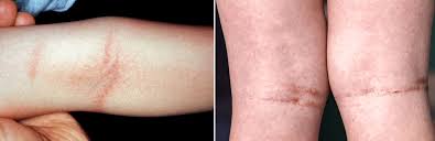 Image result for Scarlet Fever