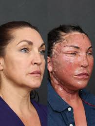 TRUST THE PROCESS: ✨Three Months Transformation: Darla's Beautiful, Natural  Rejuvenation. Darla is 54 years old and she underwent a comprehensive  facial rejuvenation that included: • Upper Blepharoplasty • Lower  Blepharoplasty • Hybrid