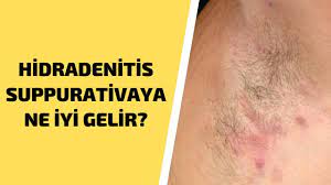 hidradenitis suppurativaya ne iyi gelir kopek memesi hastaligina iyi gelen dogal cozum youtube