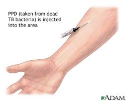 Find the latest ppd, inc. Ppd Skin Test Medlineplus Medical Encyclopedia Image