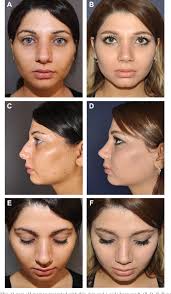 Figure 8 from The oscillating micro-saw: a safe and pliable instrument for  transverse osteotomy in rhinoplasty.