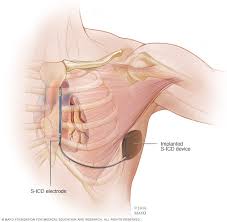 If it occurs, the icd quickly sends an electrical shock to the heart. Implantable Cardioverter Defibrillators Icds Mayo Clinic