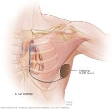 Pacemaker & icd are two different devices. Implantable Cardioverter Defibrillators Icds Mayo Clinic