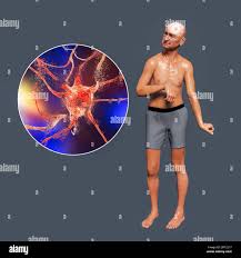 Image result for Chorea