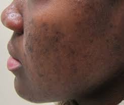 How To Get Rid Of Hyperpigmentation On Black Skin Best Hyperpigmentation Creams Black Skin Care Dark Spots Hyperpigmentation Black Skin Skin Care Dark Spots