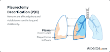 Pleurectomy and Decortication: Definition and What to Expect