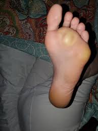Curious if anyone has seen anything like this? I do have rheumatoid  arthritis and wondering if it's related.