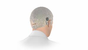 The price of their products are also reasonable. Bone Conduction Solutions For Single Sided Deafness Adhear Bonebridge Med El Professionals Blog