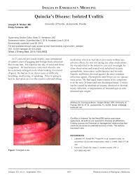 Pdf Quincke S Disease Isolated Uvulitis