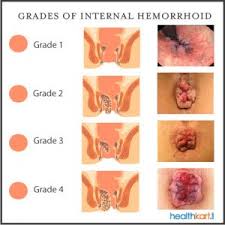 Résultat de recherche d'images pour "hemorrhoids?"