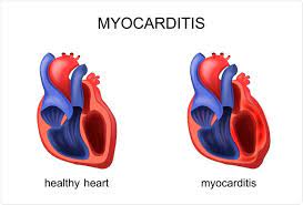 Myocarditis, or inflammation of the heart muscle, has been detected in approximately a. Long Term Effects Of Covid 19 In Athletes