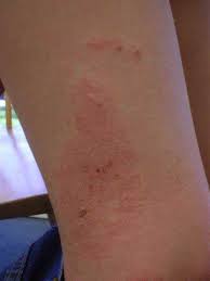 Doctors link this condition to chemical exposure. Is It A Viral Rash Baby Toddler Rash Identification Ask Dr Sears