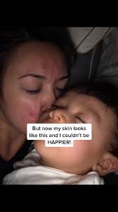 This was hard to post but wanted to give hope to those who suffer with  severe acne. #acne #WhatsYourPower #PerfectAsIAm #acnemom #makeup #iudacne
