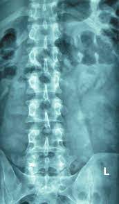 Check spelling or type a new query. Multiple Lumbar Transverse Process Stress Fractures As A Cause Of Chronic Low Back Ache In A Young Fast Bowler A Case Report Bmc Sports Science Medicine And Rehabilitation Full Text