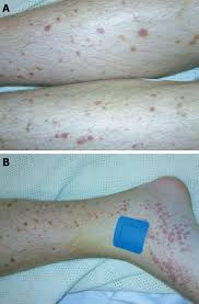 The most noticeable sign is the skin color change. Henoch Sch Ouml Nlein Purpura Complicating Adalimumab Therapy For Crohn Rsquo S Disease