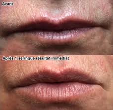 Interagir avec le mot repulper. Embellir Les Levres Par Injection D Acide Hyaluronique Dr Florence Pecha Ophtalmologue Et Medecine Esthetique A Cannes