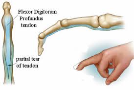 Masden abstract flexor tendon injuries within zones 3 to 5 represent those confined to the palm and distal forearm. Jersey Finger Kayvon Izadi Md Hand Wrist Elbow Orthopedic Surgeon