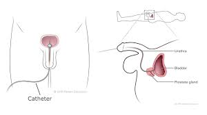 You can shower while you have your catheter in place. How To Care For Your Catheter Male At Home Youtube