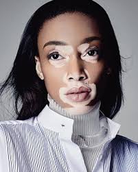 9 Vitiligo Transformations That Prove The Power Of Makeup Vitiligo Vitiligo Skin Skin Disorders
